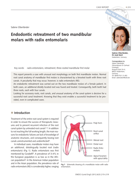 Endodontic Retreatment of Two Mandibular Molars with Radix Entomolaris