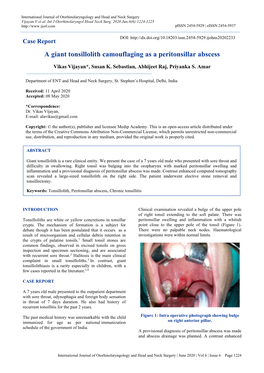 A Giant Tonsillolith Camouflaging As a Peritonsillar Abscess