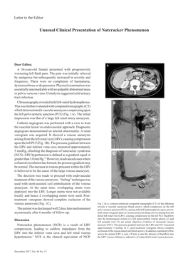 Unusual Clinical Presentation of Nutcracker Phenomenon