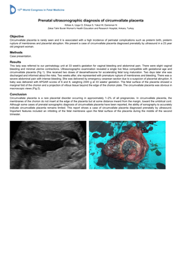 Prenatal Ultrasonographic Diagnosis of Circumvallate Placenta