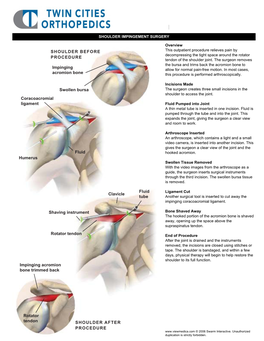 Shoulder Impingement Surgery