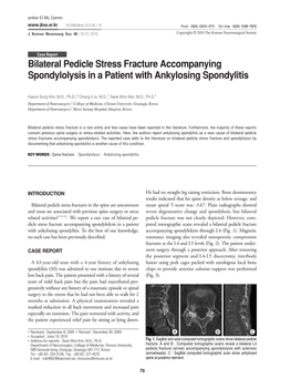 Bilateral Pedicle Stress Fracture Accompanying Spondylolysis in a Patient with Ankylosing Spondylitis