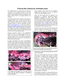 Focus On: Gingival Hyperplasia