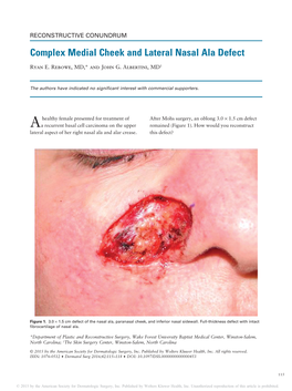 Complex Medial Cheek and Lateral Nasal Ala Defect