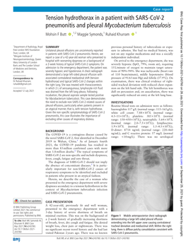 Cov-2 Pneumonitis and Pleural Mycobacterium Tuberculosis Mohsin F Butt ‍ ‍ ,1,2 Maggie Symonds,1 Ruhaid Khurram ‍ ‍ 1