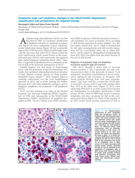 Anaplastic Large Cell Lymphoma