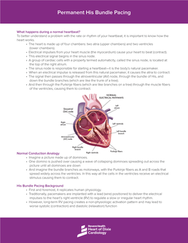 Permanent His Bundle Pacing