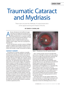 Traumatic Cataract and Mydriasis