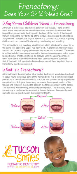 Frenectomy: Does Your Child Need One? Why Some Children Need a Frenectomy a Frenum Is a Muscular Attachment Between Two Tissues