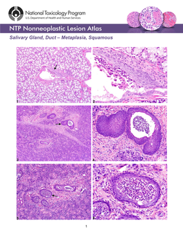 Salivary Gland, Duct – Metaplasia, Squamous