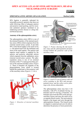 SPHENOPALATINE ARTERY (SPA) LIGATION Darlene Lubbe