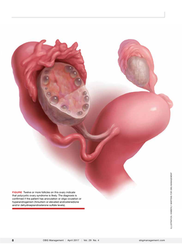 FIGURE Twelve Or More Follicles on This Ovary Indicate That Polycystic Ovary Syndrome Is Likely