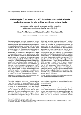 Misleading ECG Appearance of AV Block Due to Concealed AV Nodal Conduction Caused by Interpolated Ventricular Ectopic Beats