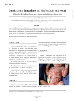 Multisystemic Langerhans Cell Histiocytosis: Case Report Histiocitose De Células De Langerhans – Forma Multissistêmica: Relato De Caso