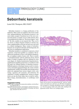 Seborrheic Keratosis