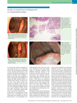 Sessile Serrated Lesion Misdiagnosed As a Hyperplastic Polyp