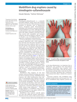 Morbilliform Drug Eruptions Caused by Trimethoprim–Sulfamethoxazole Daisuke Takenaka,1 Toshinori Nishizawa2