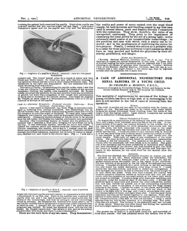 A Case of Abdominal Nephrectomy for Renal