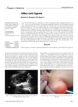 Axillary Cystic Hygroma