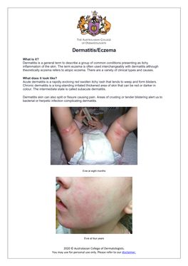 Dermatitis/Eczema