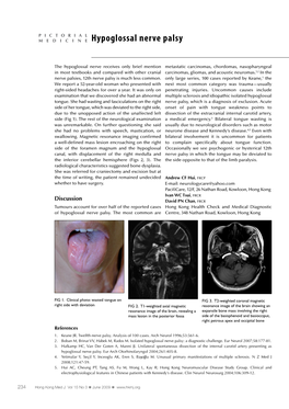 Hypoglossal Nerve Palsy