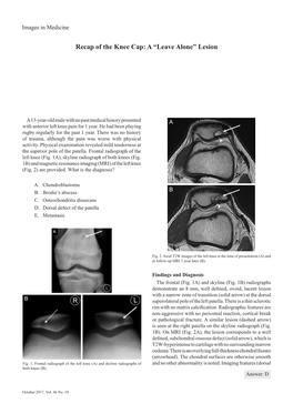 Recap of the Knee Cap: a “Leave Alone” Lesion