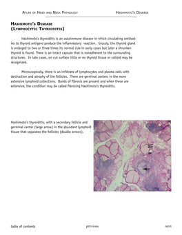 Hashimoto's Disease