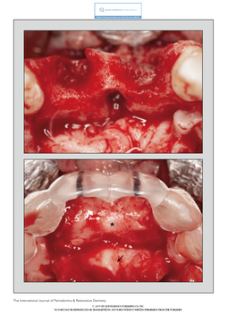 Partial Lateralization of the Nasopalatine Nerve at the Incisive