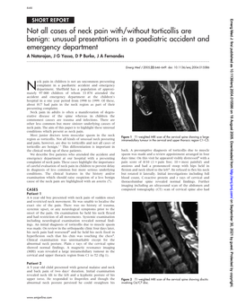 Not All Cases of Neck Pain With/Without Torticollis Are Benign: Unusual Presentations in a Paediatric Accident and Emergency