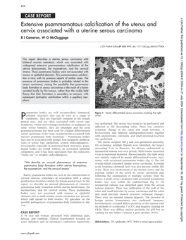 Extensive Psammomatous Calcification of the Uterus and Cervix Associated with a Uterine Serous Carcinoma R I Cameron, W G Mccluggage