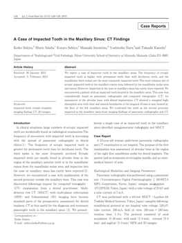 Case Reports a Case of Impacted Tooth in the Maxillary Sinus