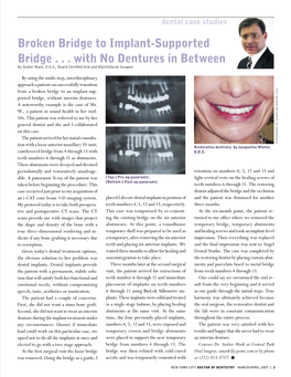 Implant Supported Bridge