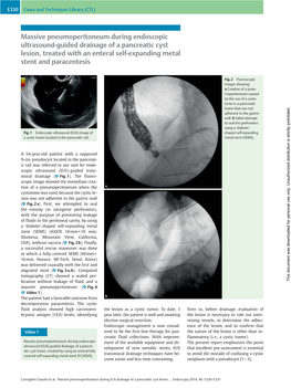 Massive Pneumoperitoneum During Endoscopic Ultrasound-Guided Drainage of a Pancreatic Cyst Lesion, Treated with an Enteral Self-Expanding Metal Stent and Paracentesis