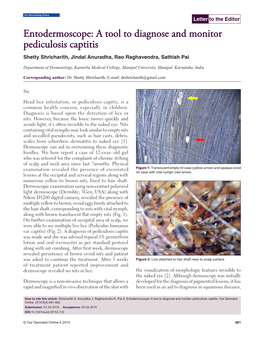 Entodermoscope: a Tool to Diagnose and Monitor Pediculosis Captitis Shetty Shricharith, Jindal Anuradha, Rao Raghavendra, Sathish Pai