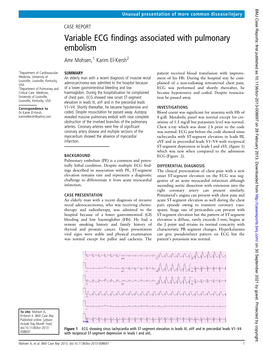 Variable ECG Findings Associated with Pulmonary Embolism