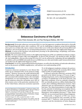 Sebaceous Carcinoma of the Eyelid Carlos Prieto-Granada, MD, and Paul Rodriguez-Waitkus, MD, Phd