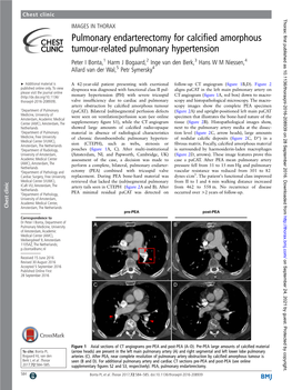 Pulmonary Endarterectomy for Calcified Amorphous Tumour-Related