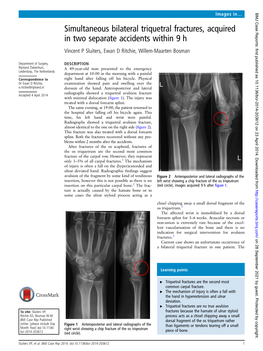 Simultaneous Bilateral Triquetral Fractures, Acquired in Two Separate Accidents Within 9 H Vincent P Sluiters, Ewan D Ritchie, Willem-Maarten Bosman