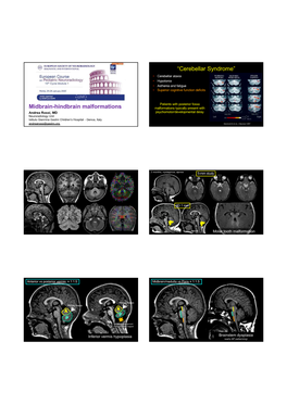 Midbrain-Hindbrain Malformations “Cerebellar Syndrome”