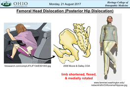 Femoral Head Dislocation (Posterior Hip Dislocation)