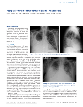 Reexpansion Pulmonary Edema Following Thoracentesis