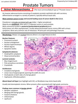 Prostate Tumors Acinar Adenocarcinoma (The Most Common/Default Type of “Prostate Cancer”)