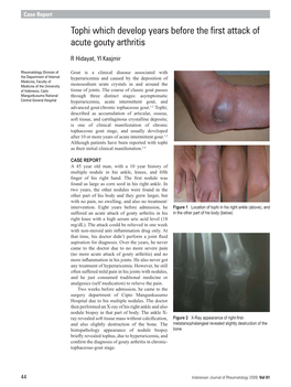 Tophi Which Develop Years Before the First Attack of Acute Gouty Arthritis