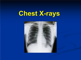 Chest X-Rays Chest X-Ray