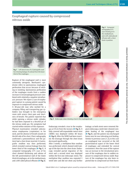 Esophageal Rupture Caused by Compressed Nitrous Oxide