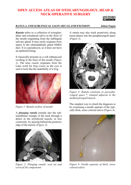 RANULA and SUBLINGUAL SALIVARY GLAND EXCISION Johan Fagan