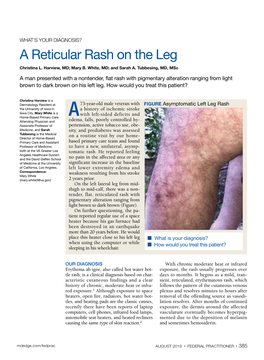 A Reticular Rash on the Leg Christina L