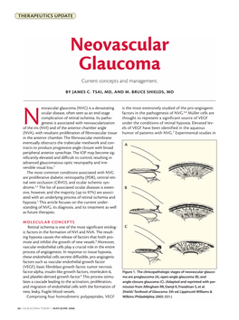 Neovascular Glaucoma Current Concepts and Management