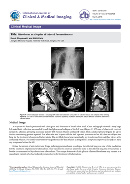 Fibrothorax As a Sequlae of Induced Pneumothoraces Kunal Bhagatwala* and Nidhi Karia Abington Memorial Hospital, 1200 Old York Road, Abington, PA, USA