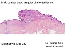 Melanocytic Slide Club Case